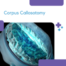 Corpus Callosotomy