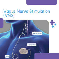 Vagus Nerve Stimulation (VNS)