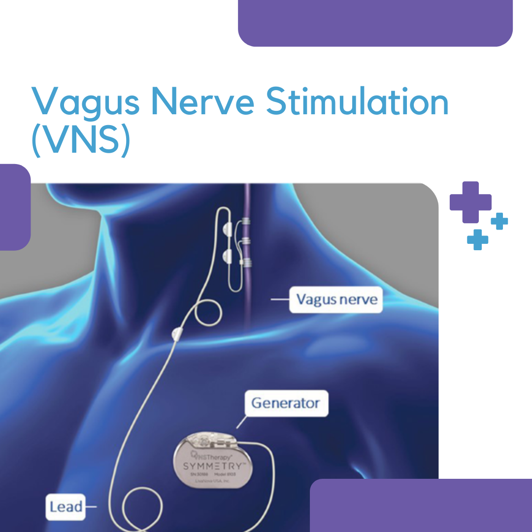 Vagus Nerve Stimulation (VNS) – Caputron